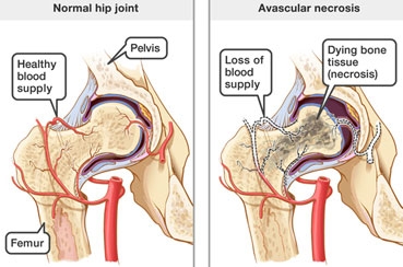 Avascular Necrosis in Sickle Cell Disease: Causes, Symptoms, and Treatment Options