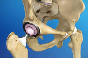 Ceramic Hip Replacement: Is It Worth the Cost?