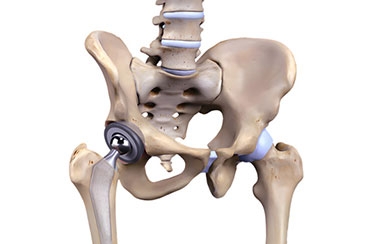 Life After Hip Replacement: How Long Do Implants Last