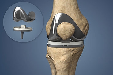 Living with a Knee Replacement: Tips for Maintaining Long-Term Mobility