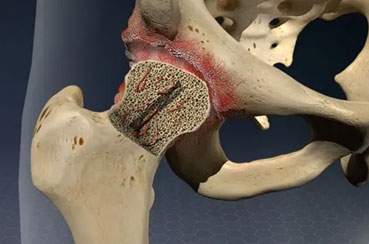 Non-Surgical Treatments for Avascular Necrosis: Can You Avoid Surgery?
