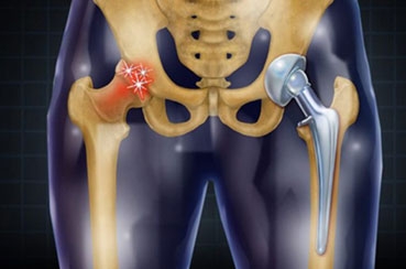 What to Expect During Hip Replacement Recovery: A Week-by-Week Guide